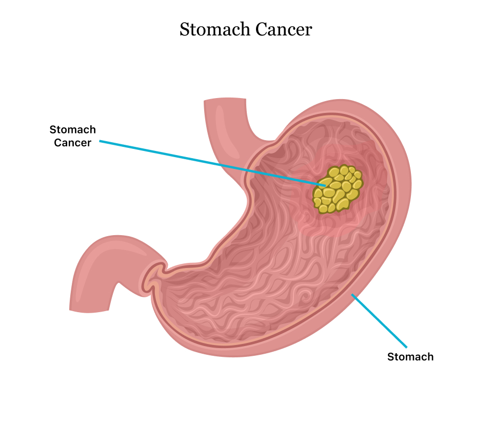 STOMACH CANCER SURGERY